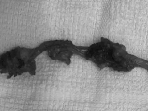 Đau âm ỉ vùng bụng, người đàn ông sốc nặng khi bác sĩ lấy ra thứ "rợn người" trong cơ thể