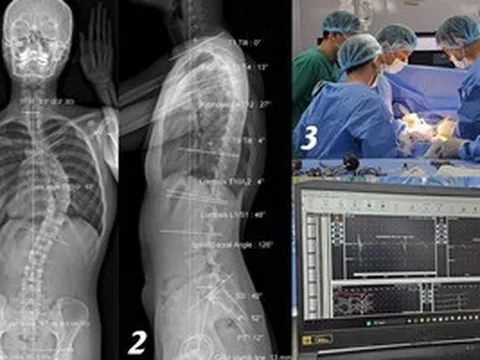 Cô gái soi gương thấy lưng có dấu hiệu lạ, không ngờ cột sống đã cong 53 độ