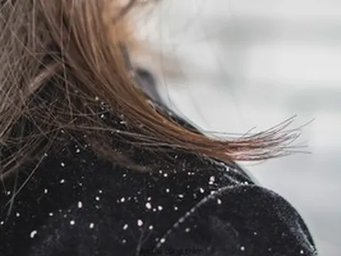 Chuyên gia cảnh báo: 50% dân số từng bị gàu nhưng điều trị chưa đúng