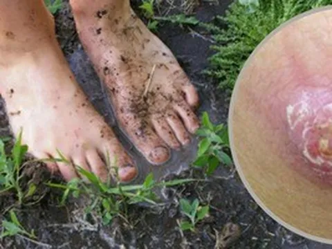 Hiểu đúng về bệnh do "vi khuẩn ăn thịt người"