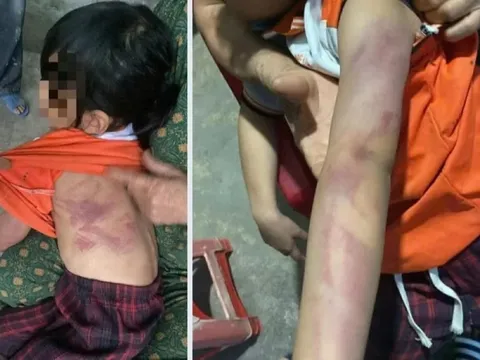 Bé gái lớp 2 bị bạn dùng thước đánh bầm tím người trong giờ ra chơi