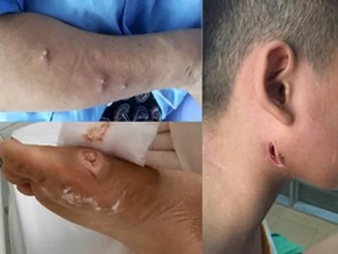 Bộ Y tế nói gì về bệnh "sốt đất" (Whitmore) sau 23 ca tử vong ở Thái Lan?