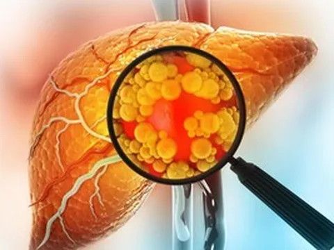 Đảo ngược gan nhiễm mỡ không cần ăn kiêng: Đột phá từ Mỹ