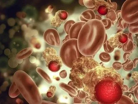 Nghiên cứu 25 năm chỉ ra 2 dấu hiệu nguy hiểm của ung thư máu