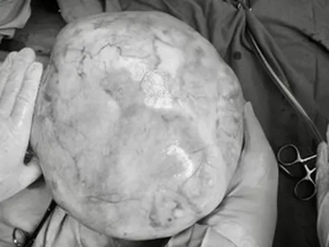 Mang khối u buồng trứng 4 kg, thiếu nữ bị nhầm là tăng cân