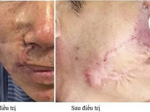 Ung thư da tái phát sau nhiều lần mổ, lan ngầm dưới da