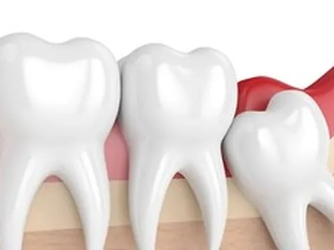 Nhổ răng khôn có được BHYT chi trả?