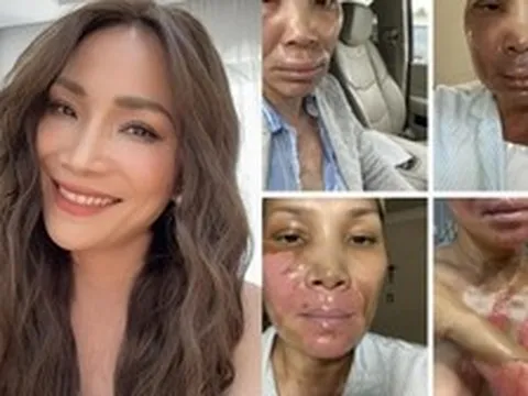 Xót xa nữ nghệ sĩ đình đám bị bỏng nghiêm trọng vì nổ nồi xông hơi: "Còn sống là hạnh phúc"