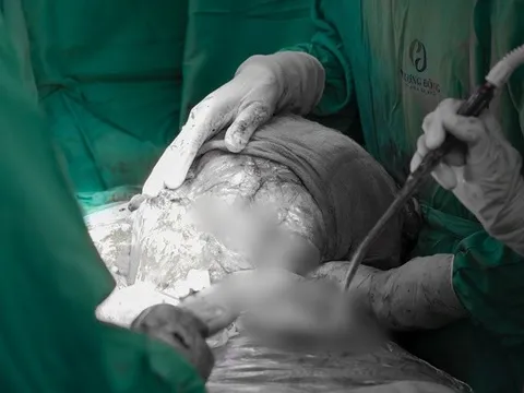 Người phụ nữ ở Hà Nội suy kiệt vì mang khối u khổng lồ 5kg