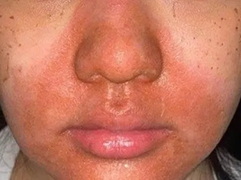 Cô gái trẻ nhập viện với gương mặt đỏ rực, bong tróc sau peel da