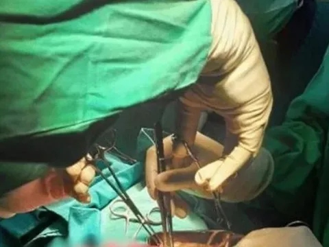 Bé trai 3 tuổi nôn ra giun, khi phẫu thuật bác sĩ phát hiện điều đáng sợ hơn