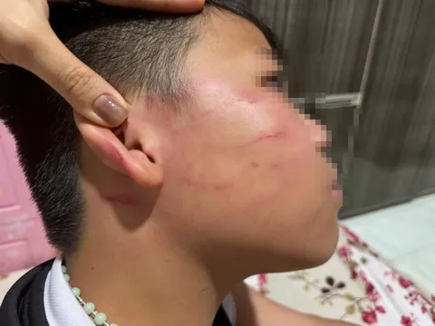 Vụ giáo viên nước ngoài tát học sinh: Gia đình nói bé trai bị thủng màng nhĩ
