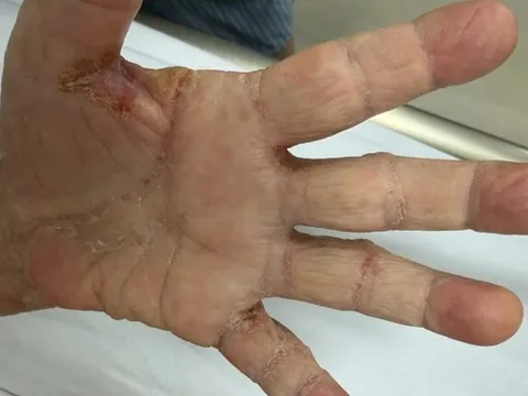 Một gia đình bị loài ký sinh trùng tưởng đã "biến mất" từ lâu tấn công