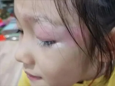 Con gái xinh xắn bỗng mọc lông mi màu trắng kỳ lạ, mẹ hoang mang đưa đến bệnh viện khám, bác sĩ lắc đầu