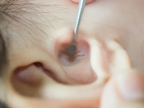 Chơi với thú cưng, bé gái 2 tuổi có bọ chét ký sinh trong tai