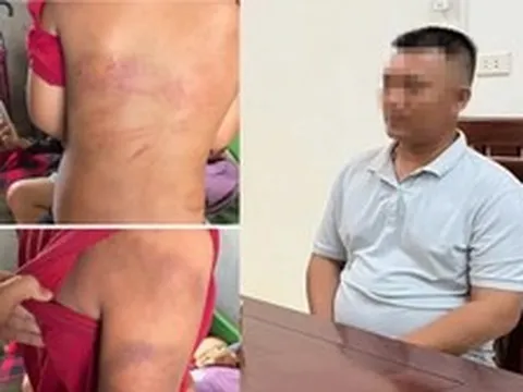Vụ bé trai 10 tuổi người thâm tím nghi bị bạo hành: Lời khai của bố đẻ