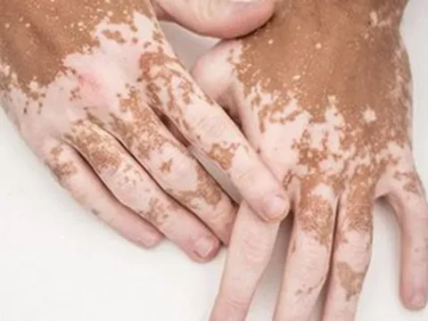 Bạch biến không lây nhưng dễ bị hiểu nhầm
