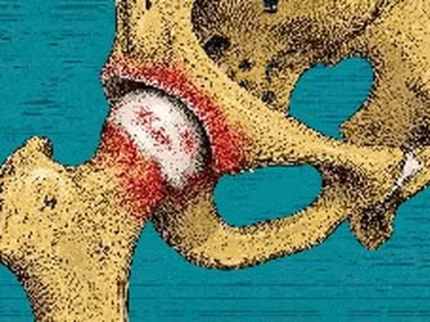Sự thật ngã ngửa về bệnh viêm khớp: Hàng thập kỷ qua chúng ta đã hiểu sai hoàn toàn?
