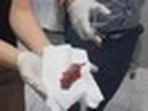 Hy hữu người đàn ông bị cá rô chui vào họng