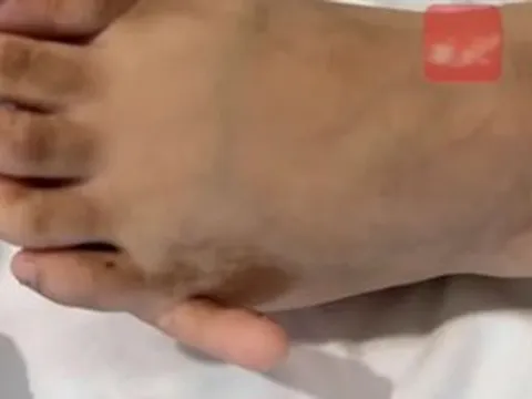 Cô gái 17 tuổi có 6 ngón tay "mọc" ra và sự thật bất ngờ