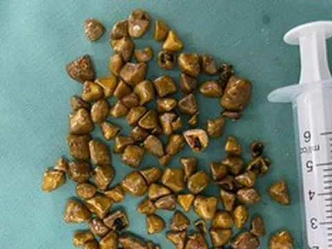 Người phụ nữ 39 tuổi đau bụng không chịu nổi, bác sĩ gắp ra thứ "đáng sợ" bên trong
