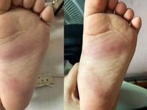 Hưng Yên: Xác minh phản ánh trẻ 3 tuổi bị bầm tím chân sau khi ở trường mầm non về