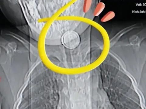 Cháu nuốt nhầm pin cúc áo, bà nội cố gắng gây nôn nhưng mẹ đứa trẻ cản, BS khen: Chị rất thông minh!