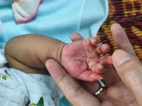 Xuất hiện dấu hiệu lạ ở da, bé 2 tháng tuổi mắc bệnh ít ai ngờ