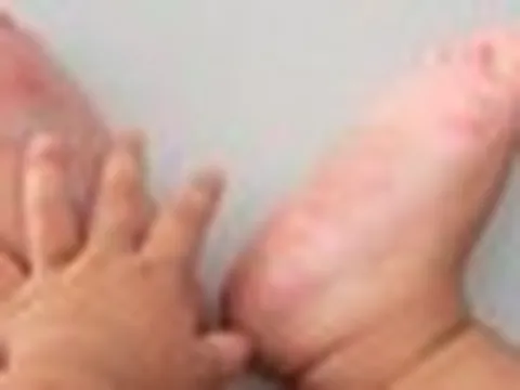 Ca mắc tay chân miệng tăng, chuyên gia khuyến cáo '3 sạch' để phòng bệnh