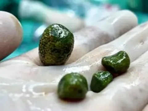 Cô gái 28 tuổi "sốc" khi bác sĩ gắp ra thứ "nổi da gà" trong bụng mình