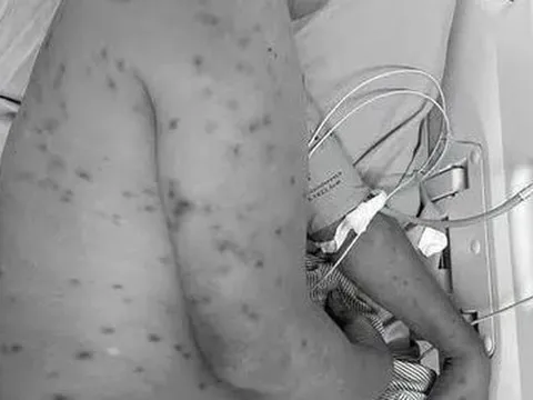 Bị hơn 300 con ong đốt, người đàn ông 62 tuổi nguy kịch