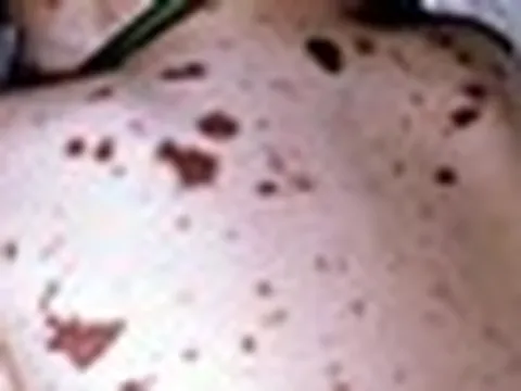 TP.HCM ghi nhận thêm 1 ca mắc viêm não mô cầu