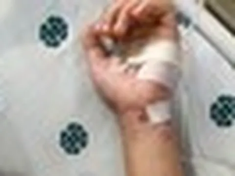 Thêm một ca não mô cầu tại TP.HCM, trẻ đã tiêm vaccine vẫn mắc bệnh: Bác sĩ cảnh báo 4 nhóm người có nguy cơ cao