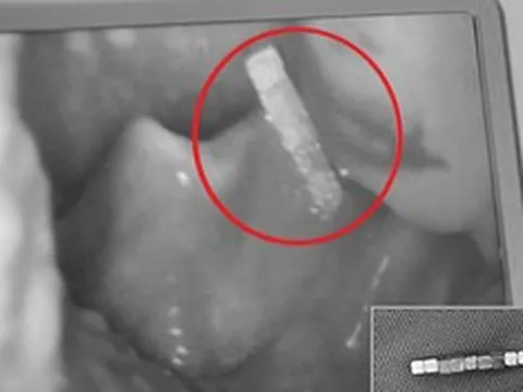 Bé trai gần 4 tuổi khó chịu ở cổ, bố mẹ kinh ngạc khi bác sĩ gắp ra thứ "đáng sợ" bên trong